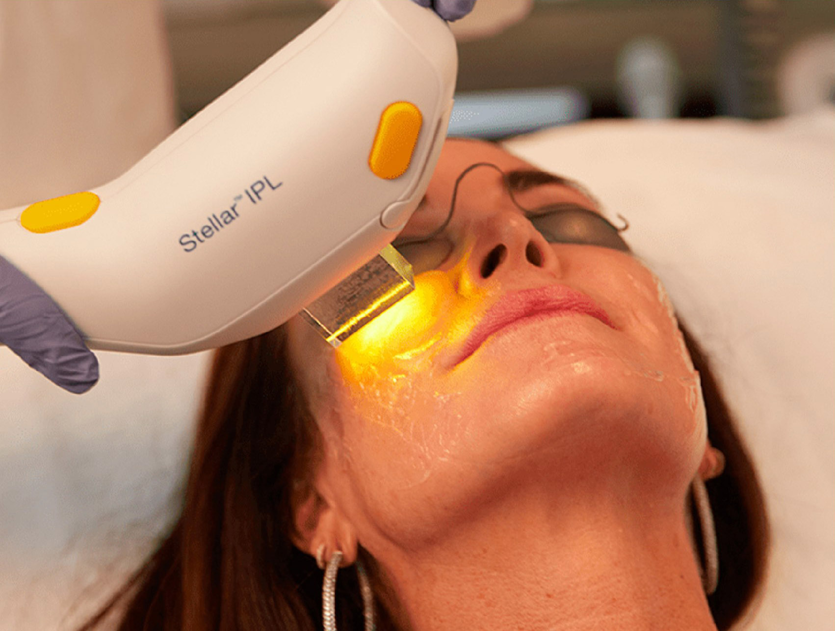IPL Photofacial Rise Wellness