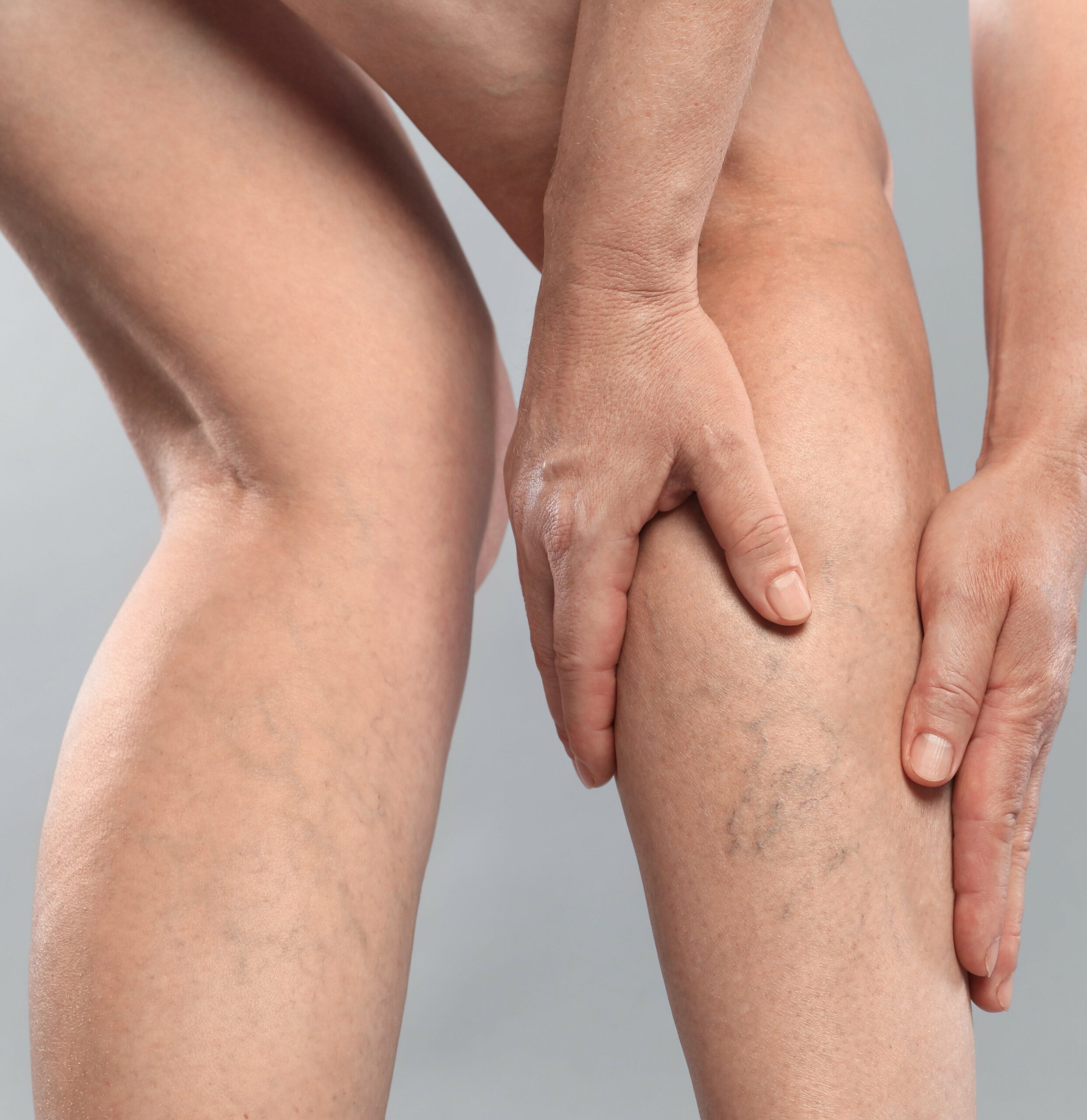 Concerns Spider Veins Concerns Spider Veins